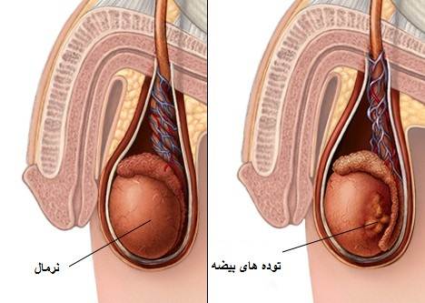 علائم سرطان بیضه
